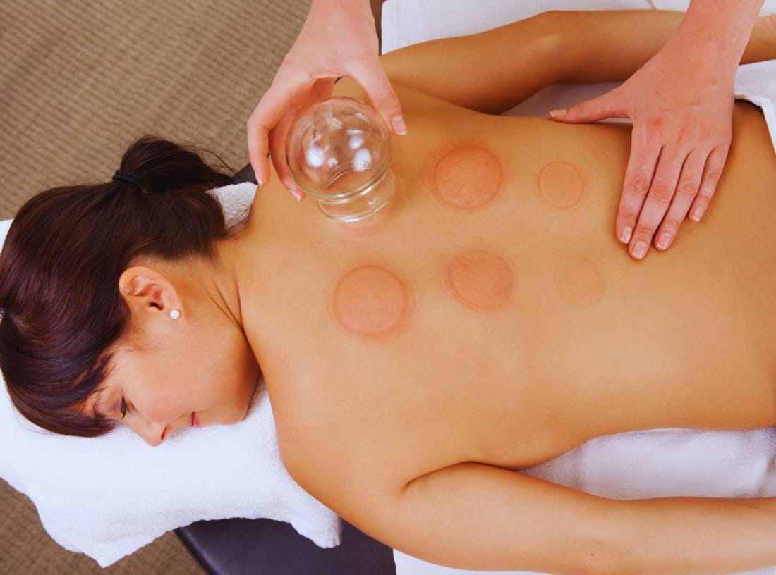 Cupping therapy on the back at Paradise Massage in Matawan, NJ